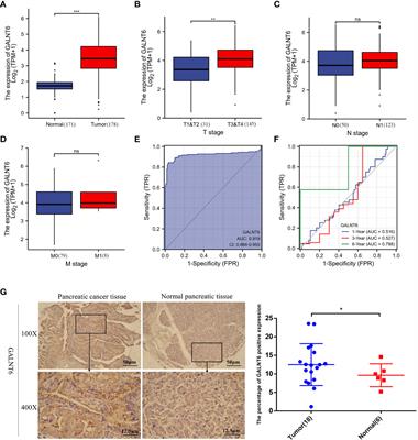 Knocking down GALNT6 promotes pyroptosis of pancreatic ductal adenocarcinoma cells through NF-κB/NLRP3/GSDMD and GSDME signaling pathway